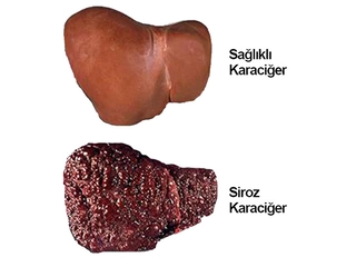Siroz Nedir Belirtileri ve Tedavisi Nelerdir?