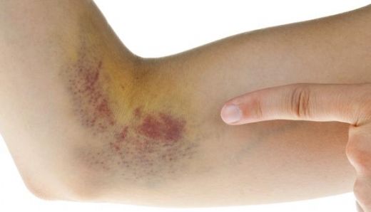 Siroz Belirtileri Nelerdir?