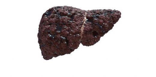 Siroz Hastalığının Son Evresi Belirtileri ve Tedavisi