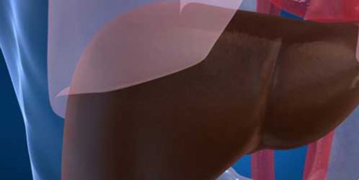 Siroz Koması Nedenleri